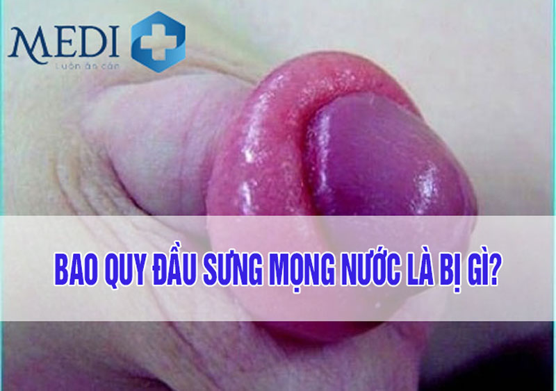 Bao quy đầu bị sưng mọng nước là bệnh gì?