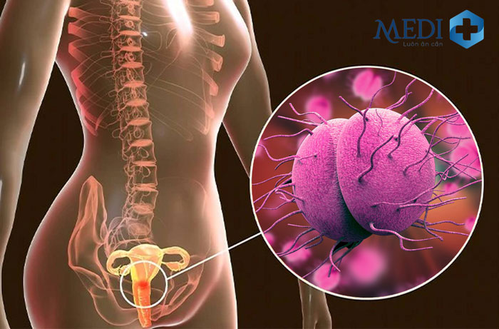 Bệnh lậu gây ra nhiều tác hại nghiêm trọng đối với khả năng sinh sản ở cả nam và nữ