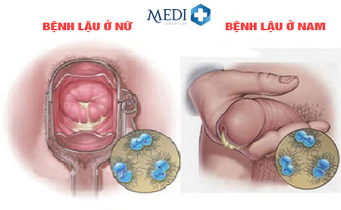 Bệnh lậu là một trong những căn bệnh nguy hiểm lây truyền qua đường tình dục