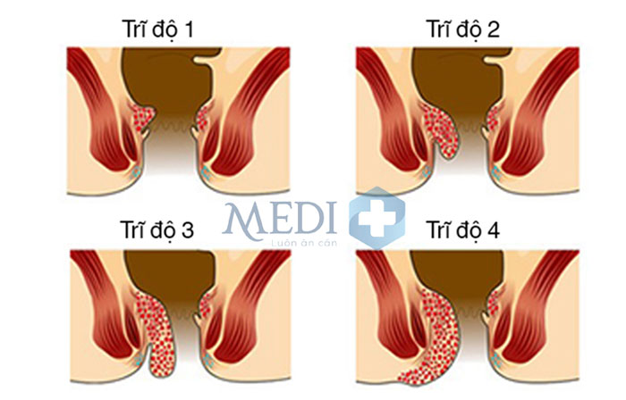 Hình ảnh các búi trĩ theo các mức độ