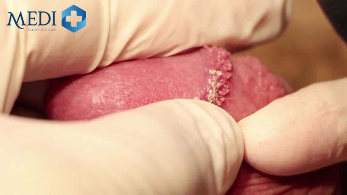 Phương pháp soi da cho kết quả chẩn đoán chuỗi hạt ngọc dương vật nhanh và chính xác hơn