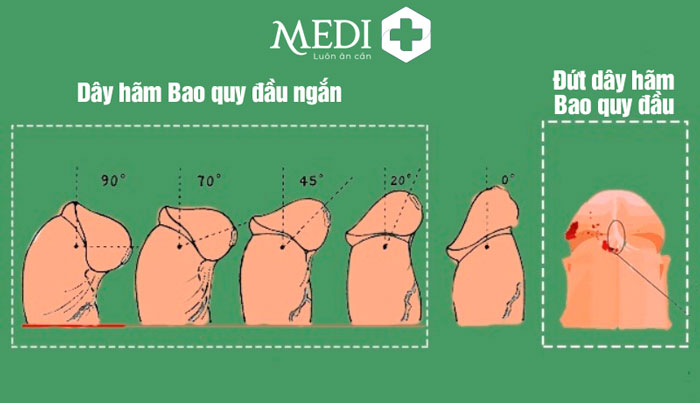 Dây hãm bao quy đầu ngắn  hoặc bị đứt gây nhiều hệ lụy không mong muốn