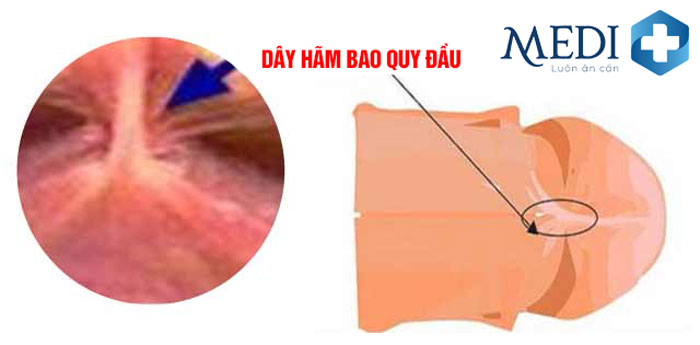 Dây hãm bao quy đầu có tạo hình chữ Y mặt dưới quy đầu