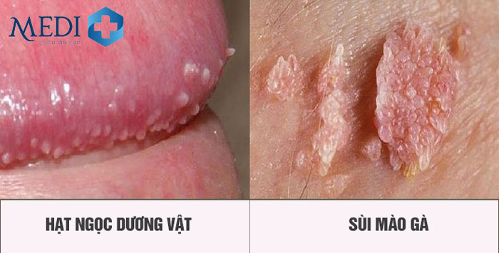 Hạt ngọc dương vật thường bị nhầm lẫn với sùi mào gà