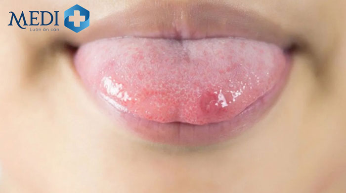 Hơn 50% ca nhiễm trùng Herpes Simplex không biểu hiện triệu chứng