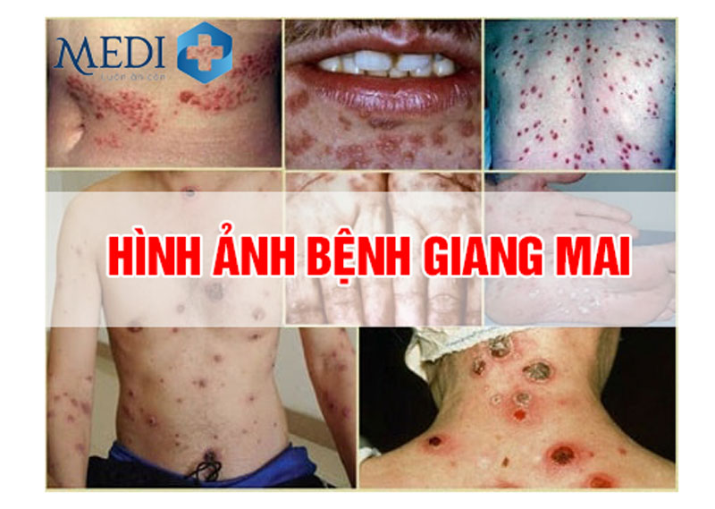 Hình ảnh bệnh giang mai qua các giai đoạn tiến triển