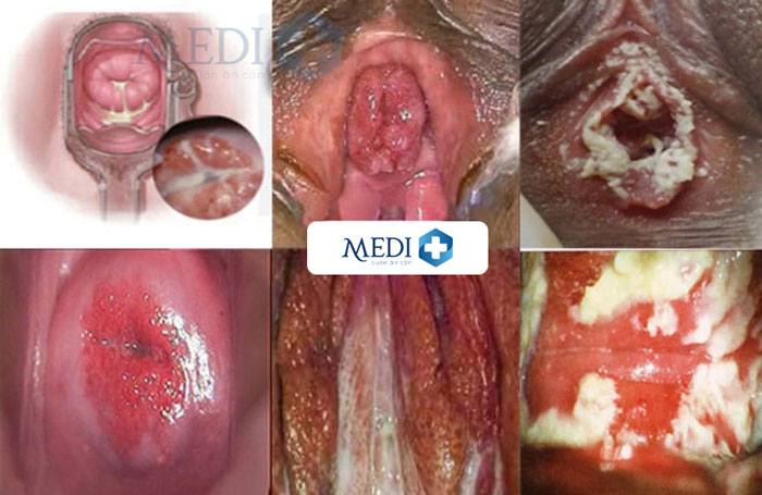 Hình ảnh bệnh lậu, lậu mủ nhận biết qua từng giai đoạn ở cả nam và nữ 
