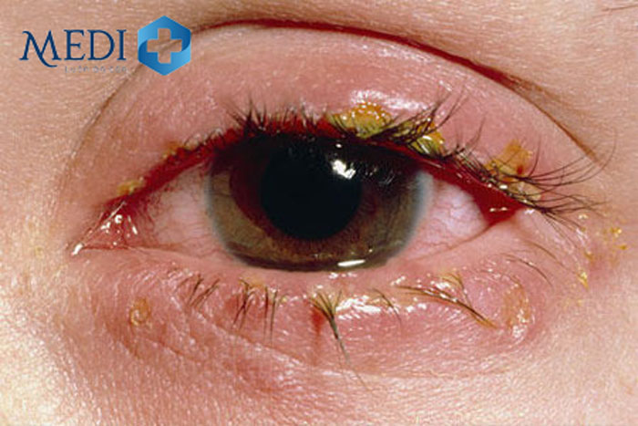 Bệnh lậu ở mắt gây nên tình trạng viêm kết mạc mắt