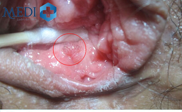Hình ảnh bệnh lậu ở nữ với các vết viêm mủ bên trong vùng kín