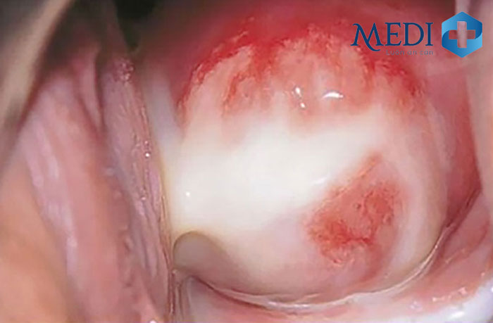 Viêm nhiễm chảy mủ vùng kín là những triệu chứng điển hỉnh khi nhiễm khuẩn lậu