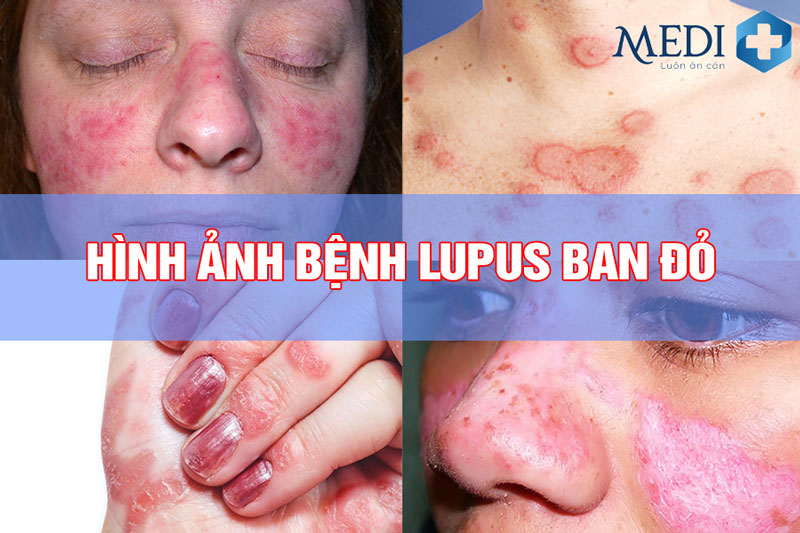 Hình ảnh bệnh lupus ban đỏ với các vết loét trên người
