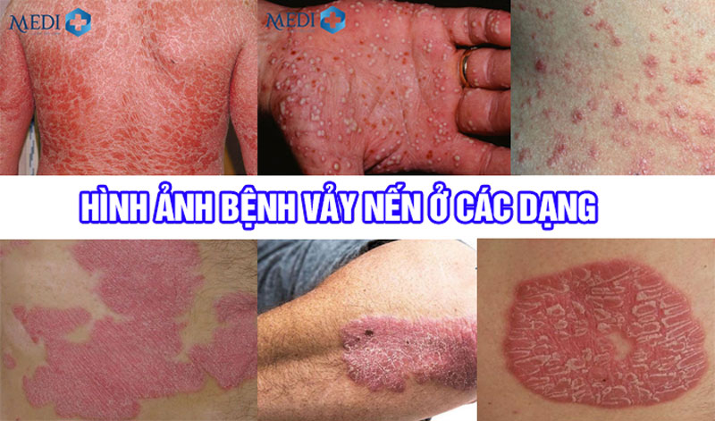 Hình ảnh bệnh vảy nến có mủ và mảng bám