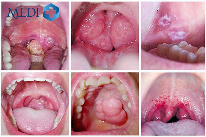 Giang mai ở miệng và bên trong vòm họng