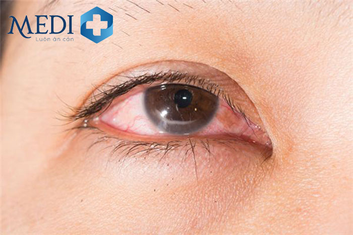 Lupus ban đỏ gây khô mắt và dễ kích ứng