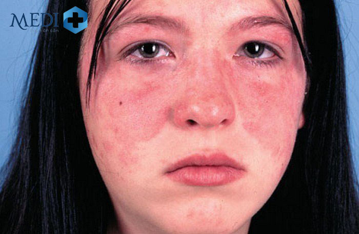 Lupus ban đỏ gây khô mắt và dễ kích ứng