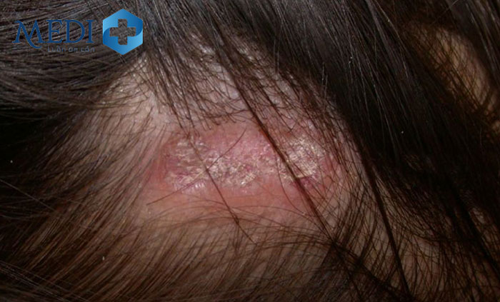 Rụng tóc là một biến chứng mà bệnh lupus ban đỏ có thể gây ra