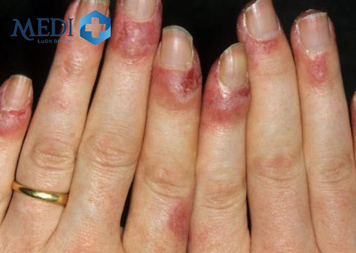 Bệnh nhân bị rụng, nứt móng tay khi mắc lupus ban đỏ