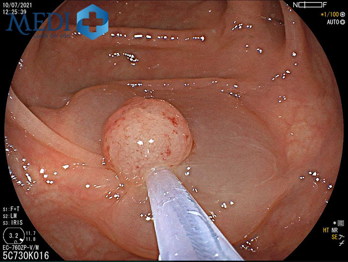 Hình ảnh polyp đại tràng kích thước lớn có nguy cơ phát triển ung thư