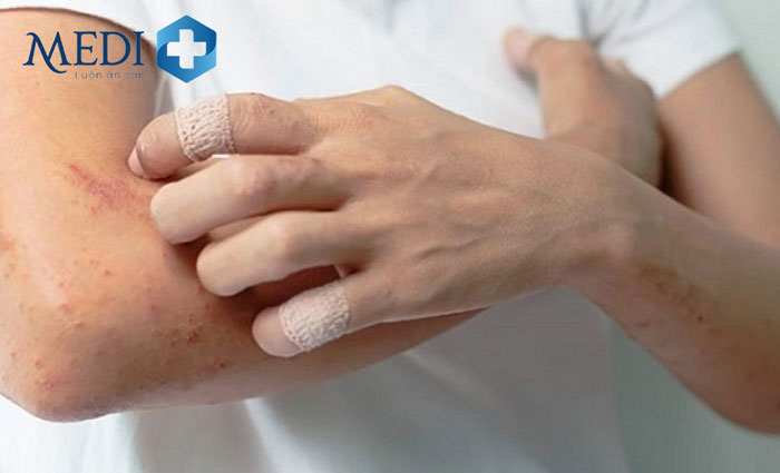 Gel su bạc giúp rút ngắn thời gian làm lành vết trầy xước, viêm nhiễm trên da