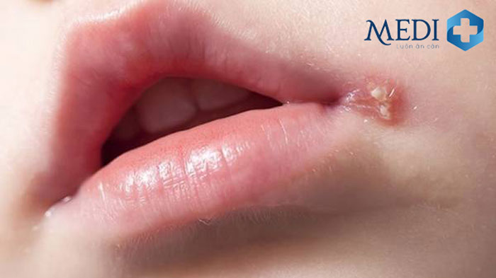 Mụn rộp sinh dục ở miệng sẽ biểu hiện triệu chứng sau khoảng 2-12 ngày