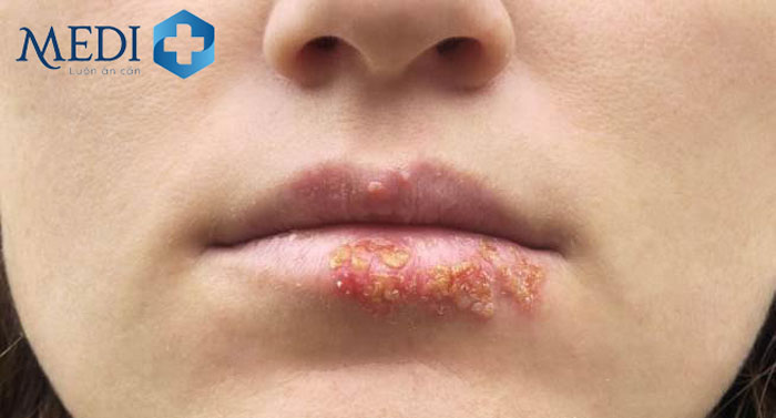 Mụn rộp sinh dục ở miệng chủ yếu do virus Herpes Simplex 1 gây ra
