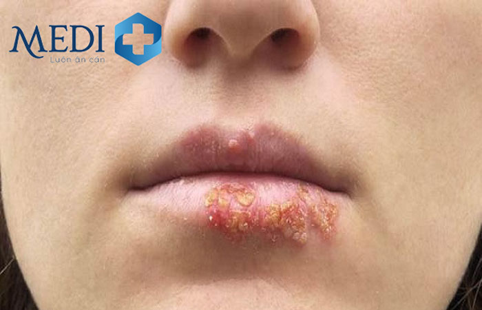Mụn rộp HSV tại miệng ở giai đoạn sơ nhiễm 