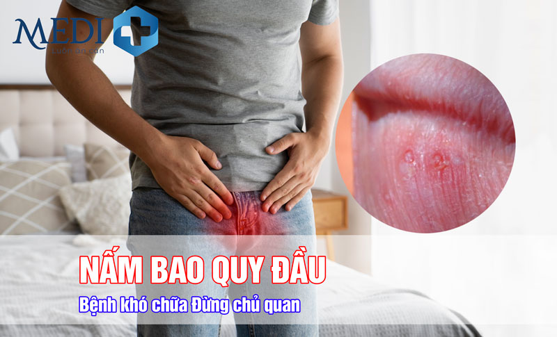 Nấm bao quy đầu: Bệnh khó chữa đừng chủ quan