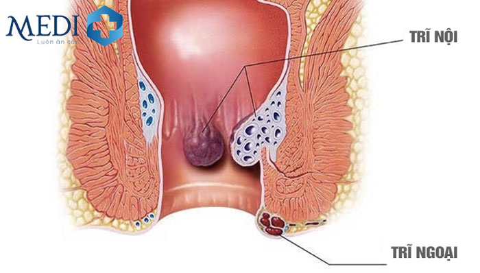 Sa búi trĩ có thể xảy ra ở cả trĩ nội, trĩ ngoại và cả trĩ hỗn hợp