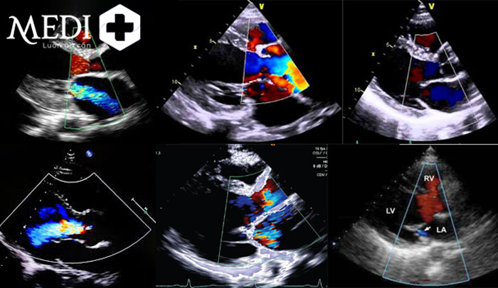 Siêu âm doppler tim được chỉ định ở bệnh nhân có bệnh lý tim mạch và cao huyết áp