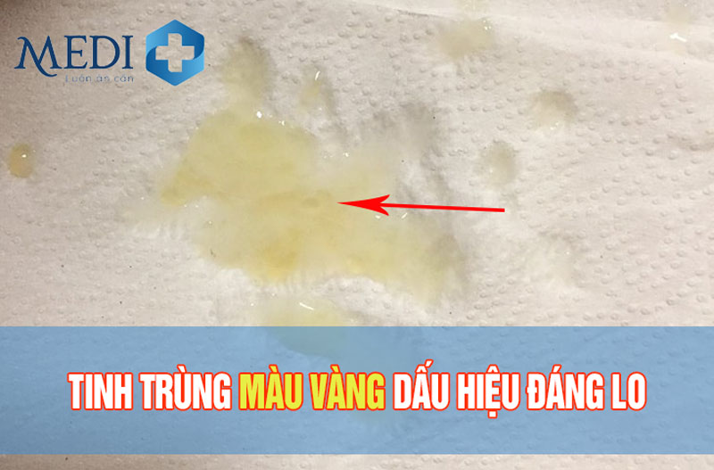 Tinh trùng màu vàng do nhiều vấn đề bệnh lý cần lưu ý