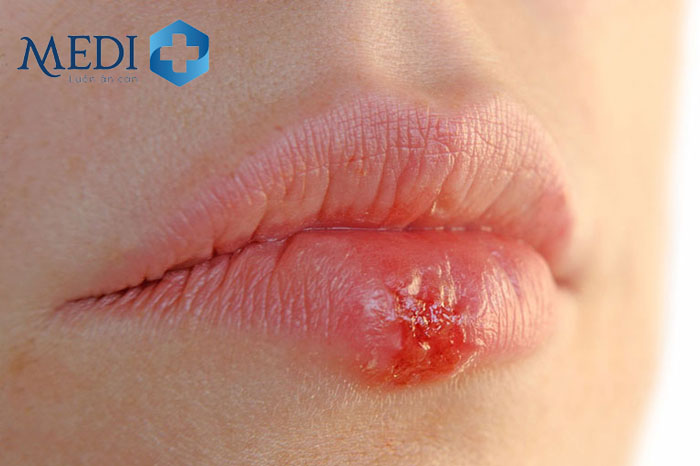 Người mắc mụn rộp sinh dục ở miệng có thể xuất hiện triệu chứng ban đầu tại vị trí nhiễm trùng