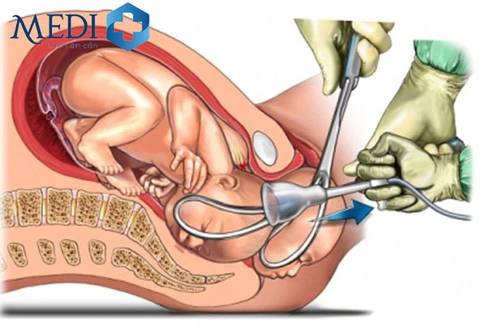 Sinh giúp bằng dụng cụ giác hút hoặc forceps