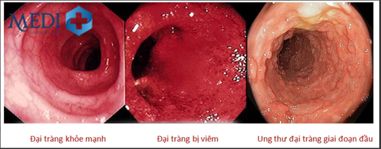 ung-thu-dai-trang-gd1