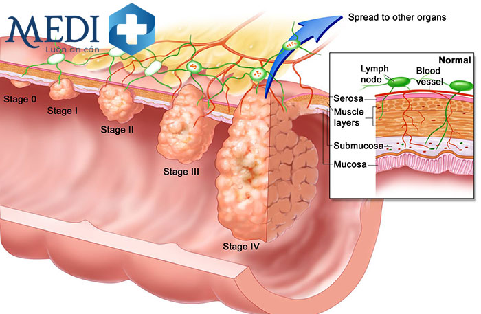 Ung thư đại trạng giai đoạn cuối tiến triển nặng và di căn nhiều chỗ