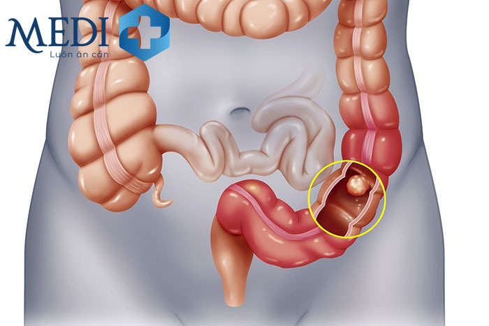 Ung thư đại tràng giai đoạn 2 cũng được chia thành các giai đoạn nhỏ hơn