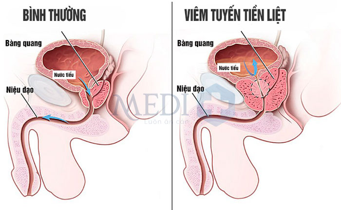 Viêm tuyến tiền liệt cũng là nguyên nhân khiến tinh trùng màu vàng