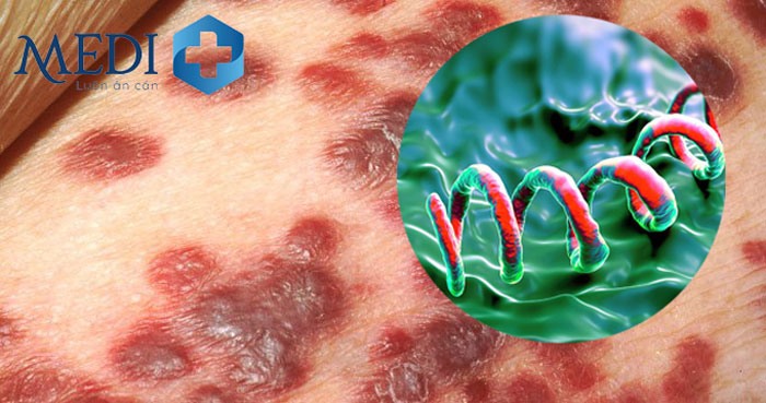 Hình ảnh xoắn khuẩn Treponema pallidum gây bệnh giang mai