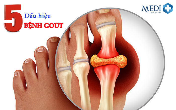 Top 5 dấu hiệu bệnh gout dễ nhận biết sớm qua từng giai đoạn