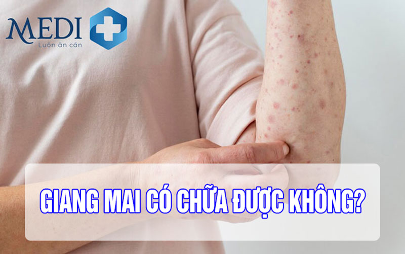 Bệnh giang mai có chữa được không? Bằng cách nào?