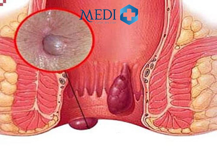 Bệnh trĩ ngoại do các đám rối tĩnh mạch dưới đường lược bị giãn