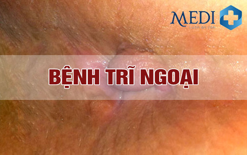 Bệnh trĩ ngoại: Nguyên nhân, triệu chứng và cách điều trị