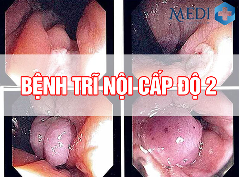 Trĩ nội độ 2 có nguy hiểm không? Cách điều trị an toàn, hiệu quả