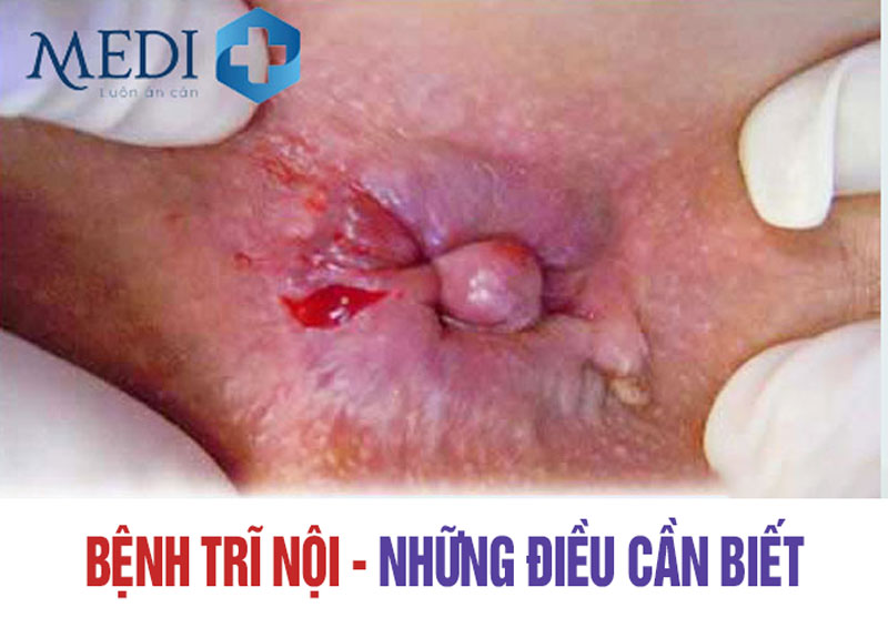 Bệnh trĩ nội – Tất tần tật những điều cần biết