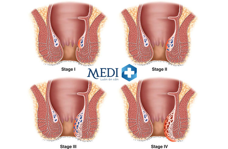 Trĩ nội độ 1 và các cấp độ trĩ nội