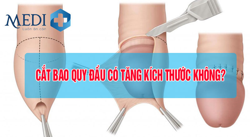 Cắt bao quy đầu có tăng kích thước không?