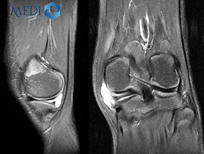 Chụp cộng hưởng từ khớp gối chẩn đoán các vấn đề bệnh lý gặp phải
