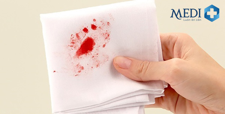 Đi ngoài ra máu là dấu hiệu điển hình cảnh báo bệnh trĩ