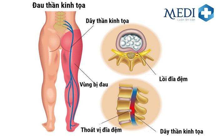 Đau dây thần kinh tọa tập trung ở một bên của cơ thể