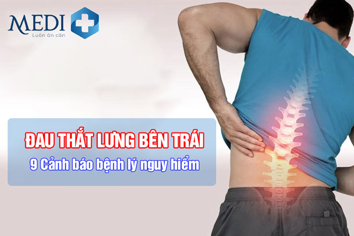 Người bệnh không nên chủ quan khi bị đau thắt lưng bên trái