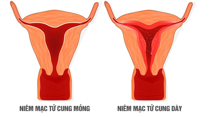 Độ dày của lớp niêm mạc có ảnh hưởng đến khả năng thụ thai của người phụ nữ